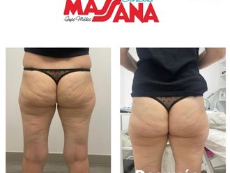 Carboxiterapia antes y después - 880189