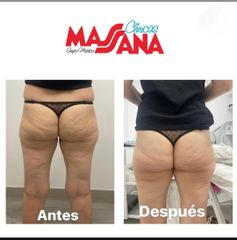 Carboxiterapia - Grupo Médico Clínicas Massana