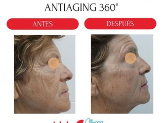 Eliminación arrugas antes y después - 880190