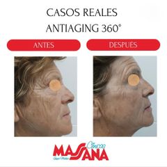 Rejuvenecimiento facial - Grupo Médico Clínicas Massana