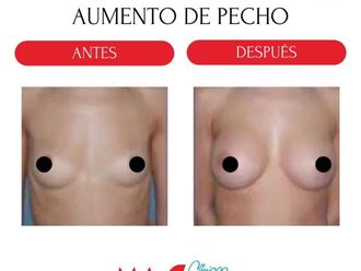 Aumento de pecho antes y después - 880191