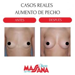Aumento de pecho - Grupo Médico Clínicas Massana