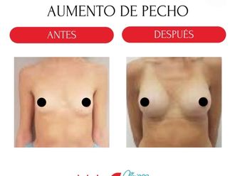 Aumento de pecho antes y después - 880192