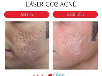Tratamiento antiacné antes y después - 880193