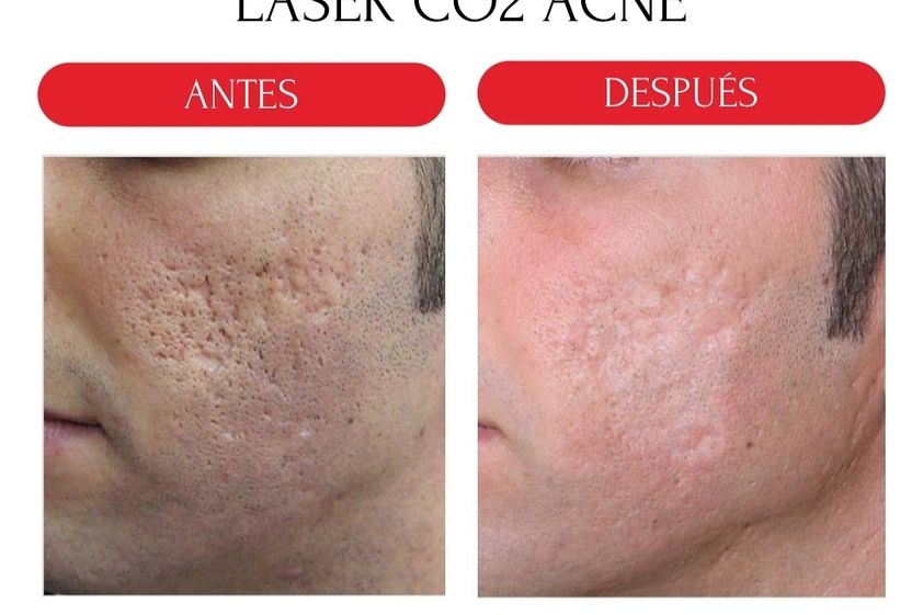 Tratamiento antiacné antes y después - 880193