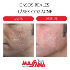 Láser CO2 - Grupo Médico Clínicas Massana