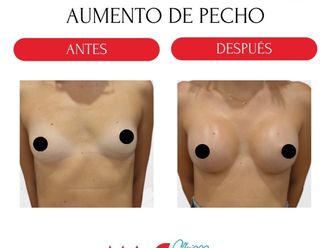Aumento de pecho antes y después - 880194