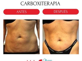 Carboxiterapia antes y después - 880195