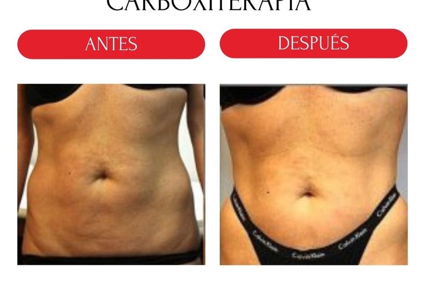 Carboxiterapia antes y después - 880195