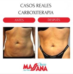 Carboxiterapia - Grupo Médico Clínicas Massana