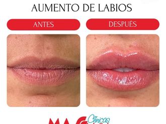 Aumento labios antes y después - 880196
