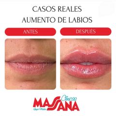 Aumento de pecho - Grupo Médico Clínicas Massana