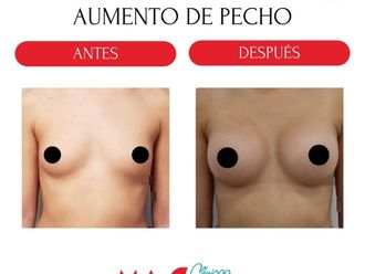 Aumento de pecho antes y después - 880197