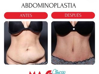 Abdominoplastia antes y después - 880198