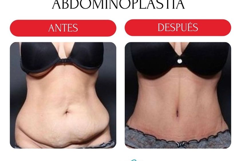 Abdominoplastia antes y después - 880198