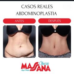 Abdominoplastia - Grupo Médico Clínicas Massana
