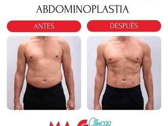 Abdominoplastia antes y después - 880199