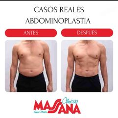 Abdominoplastia - Grupo Médico Clínicas Massana