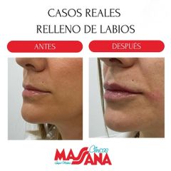 Relleno de labios - Grupo Médico Clínicas Massana