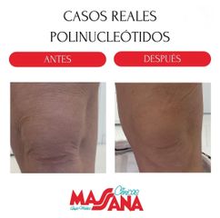 Polinucleótidos - Grupo Médico Clínicas Massana