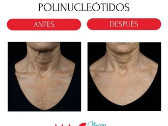Rejuvenecimiento facial antes y después - 880237