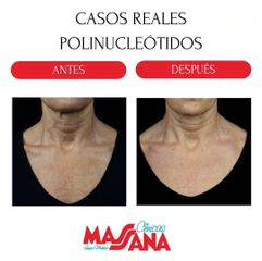 Polinucleótidos - Grupo Médico Clínicas Massana