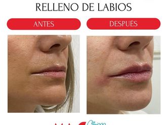 Aumento labios antes y después - 880238