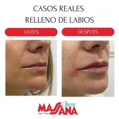 Relleno de labios - Grupo Médico Clínicas Massana