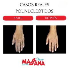 Polinucleótidos - Grupo Médico Clínicas Massana