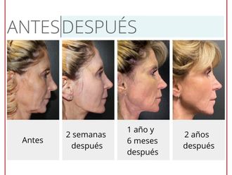 Rejuvenecimiento facial antes y después - 880241