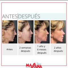 Rejuvenecimiento facial - Grupo Médico Clínicas Massana