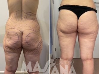 Aumento glúteos antes y después - 880242