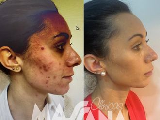 Tratamiento antiacné antes y después - 880243