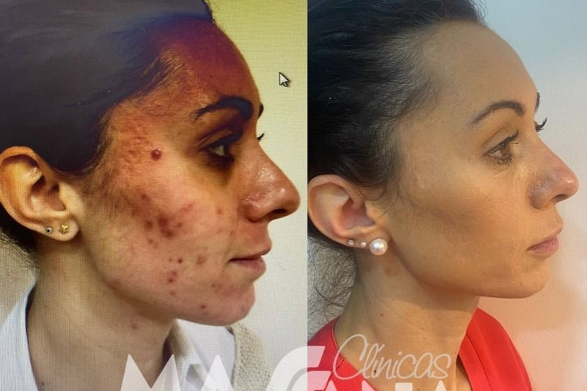 Tratamiento antiacné antes y después - 880243