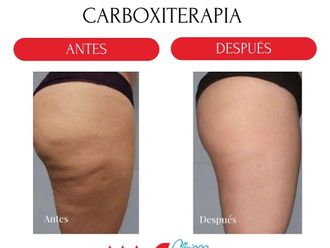 Carboxiterapia antes y después - 880244