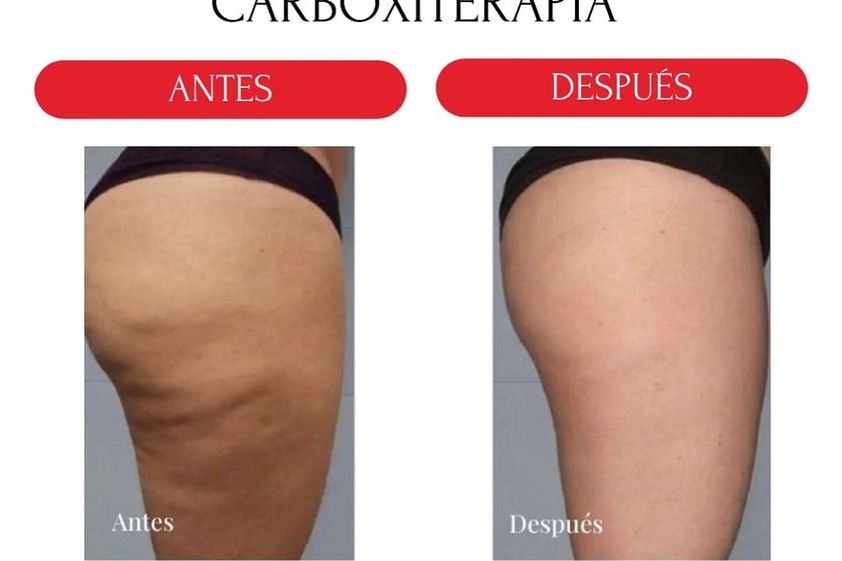 Carboxiterapia antes y después - 880244