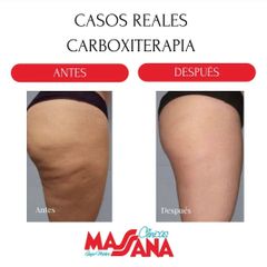 Carboxiterapia - Grupo Médico Clínicas Massana