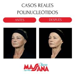 Polinucleótidos - Grupo Médico Clínicas Massana