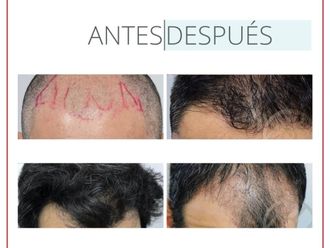 Tratamiento capilar antes y después - 880246