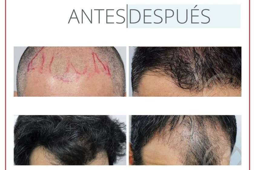 Tratamiento capilar antes y después - 880246