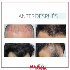 tratamiento capilar - Grupo Médico Clínicas Massana