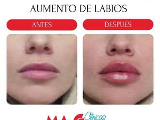 Aumento labios antes y después - 880247