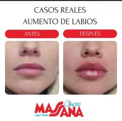 Aumento de labios - Grupo Médico Clínicas Massana