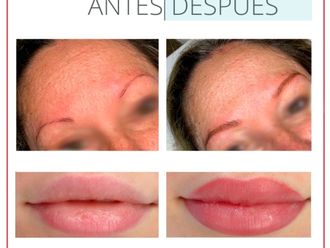Micropigmentación antes y después - 880248
