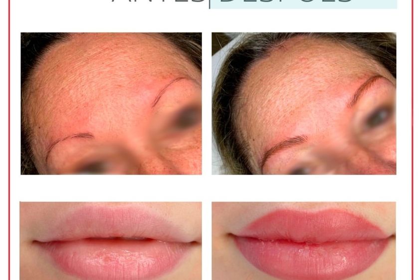 Micropigmentación antes y después - 880248