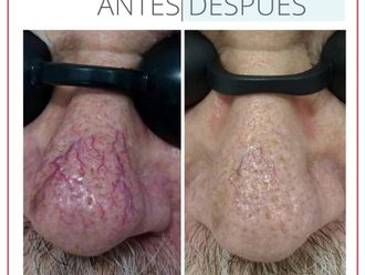 Tratamiento varices antes y después - 880249