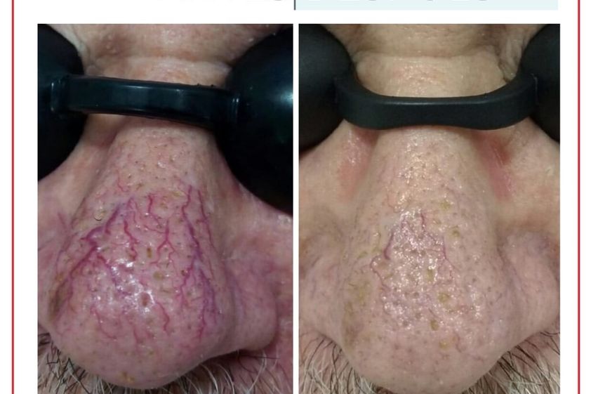 Tratamiento varices antes y después - 880249