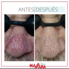 Tratamiento varices - Grupo Médico Clínicas Massana