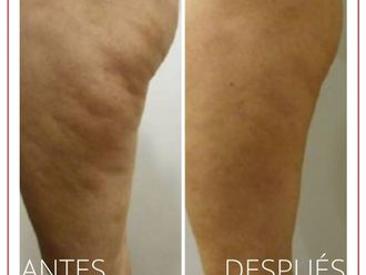 Celulitis antes y después - 880250