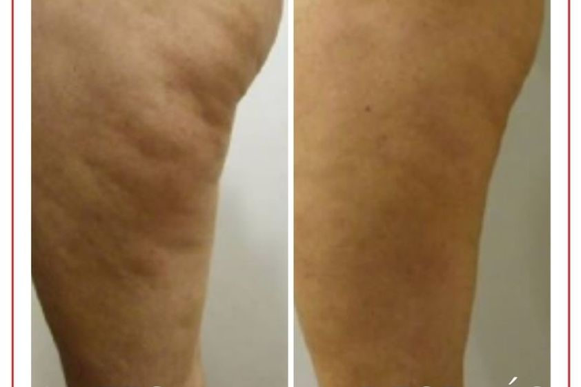 Celulitis antes y después - 880250